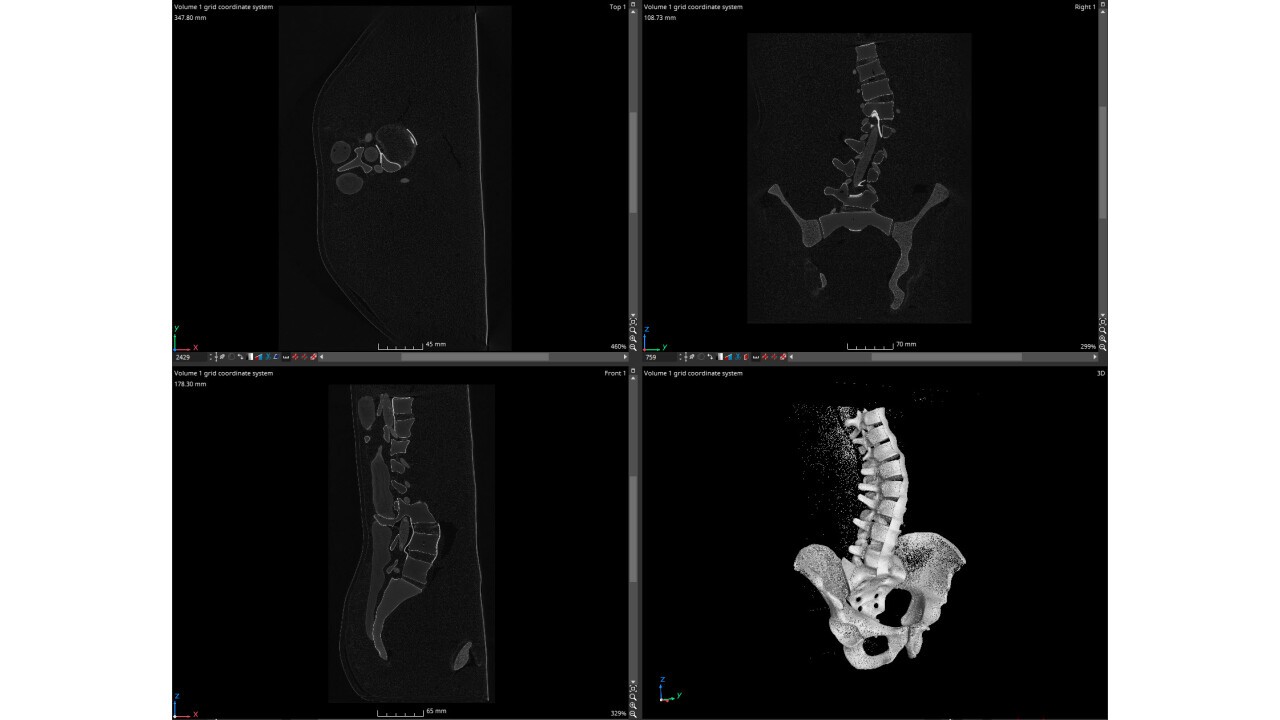 CT-Bilder des Modells mit Skoliose-Deformität